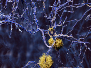 Alzheimer disease neuron with amyloid plaques