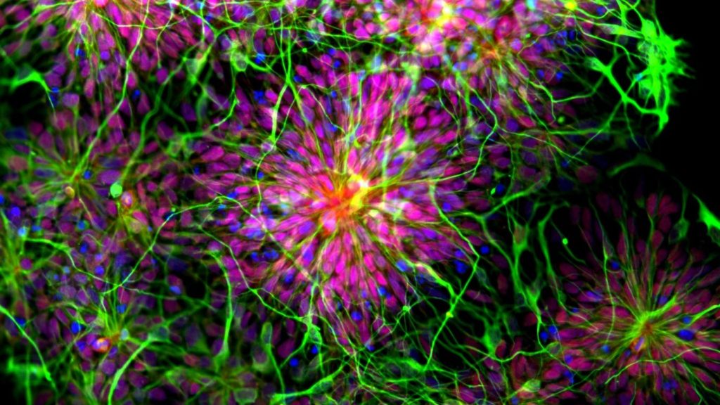 Magnified image of human neurones in pink green and yellow
