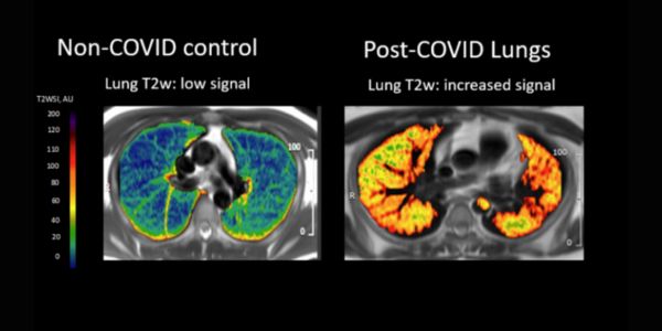 The-MRI-scans-revealed-abnormalities-in-the-lungs-of-some-of-the-patients-who-had-been-hospitalised-with-COVID-19