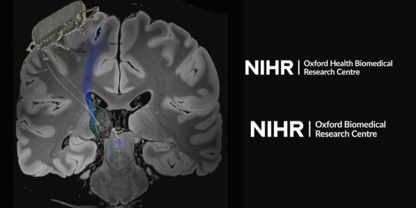 Study tests whether deep brain stimulation can treat chronic pain